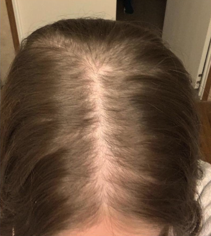 Înainte de rutina Regen Expert — cărare lărgită, scalp vizibil
